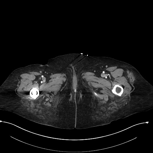 File:Active renal extravasation with large subcapsular and retroperitoneal hemorrhage (Radiopaedia 60975-68796 Axial 216).jpg