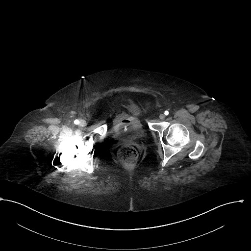 File:Active renal extravasation with large subcapsular and retroperitoneal hemorrhage (Radiopaedia 60975-68796 Axial C+ arterial phase 190).jpg