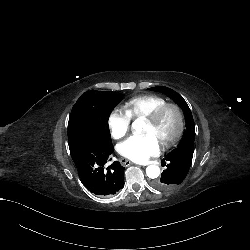 File:Active renal extravasation with large subcapsular and retroperitoneal hemorrhage (Radiopaedia 60975-68796 Axial C+ arterial phase 5).jpg