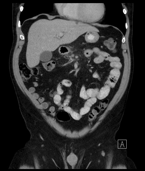 Acute-on-chronic pancreatitis (Radiopaedia 67286-76656 Coronal C+ portal venous phase 30).jpg