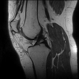 Acute-on-chronic transient lateral patellar dislocation with trochlear dysplasia (Radiopaedia 84099-99349 Sagittal PD 82).jpg