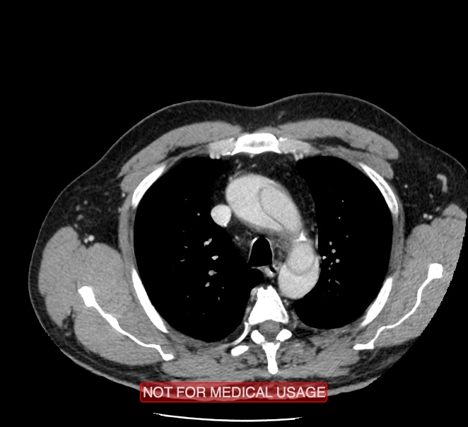 Acute aortic dissection - Stanford type A (Radiopaedia 40661-43285 Axial C+ portal venous phase 6).jpg