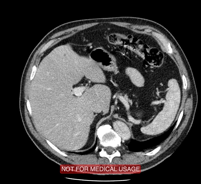 Acute aortic dissection - Stanford type A (Radiopaedia 40661-43285 Axial C+ portal venous phase 68).jpg