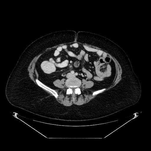 Acute appendicitis, heterotaxy syndrome (Radiopaedia 66884-76202 Axial C+ portal venous phase 80).jpg