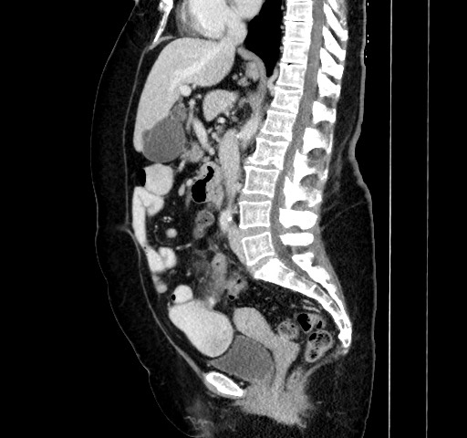 File:Acute appendicitis, heterotaxy syndrome (Radiopaedia 66884-76202 Sagittal C+ portal venous phase 70).jpg