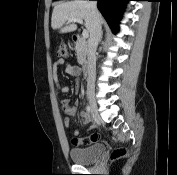 Acute appendicitis (Radiopaedia 38255-40270 Sagittal C+ portal venous phase 37).jpg