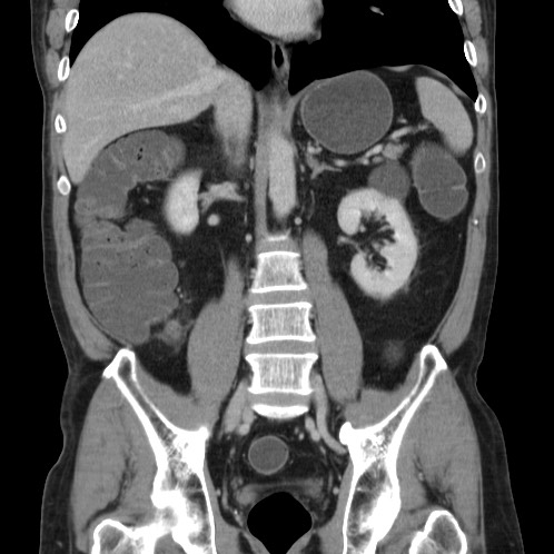 Acute appendicitis (Radiopaedia 66513-75790 Coronal C+ portal venous phase 49).jpg