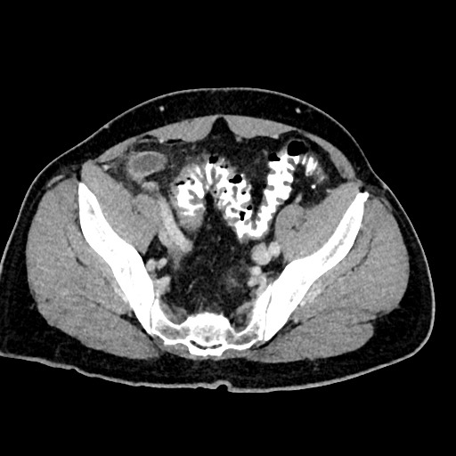 Acute appendicitis (Radiopaedia 77016-88960 Axial C+ portal venous phase 116).jpg