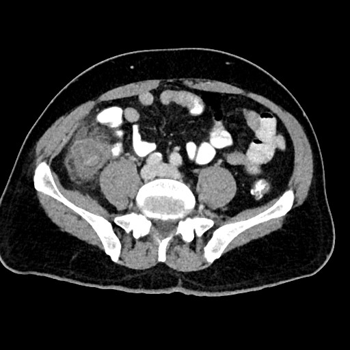 Acute appendicitis (Radiopaedia 77016-88960 Axial C+ portal venous phase 96).jpg
