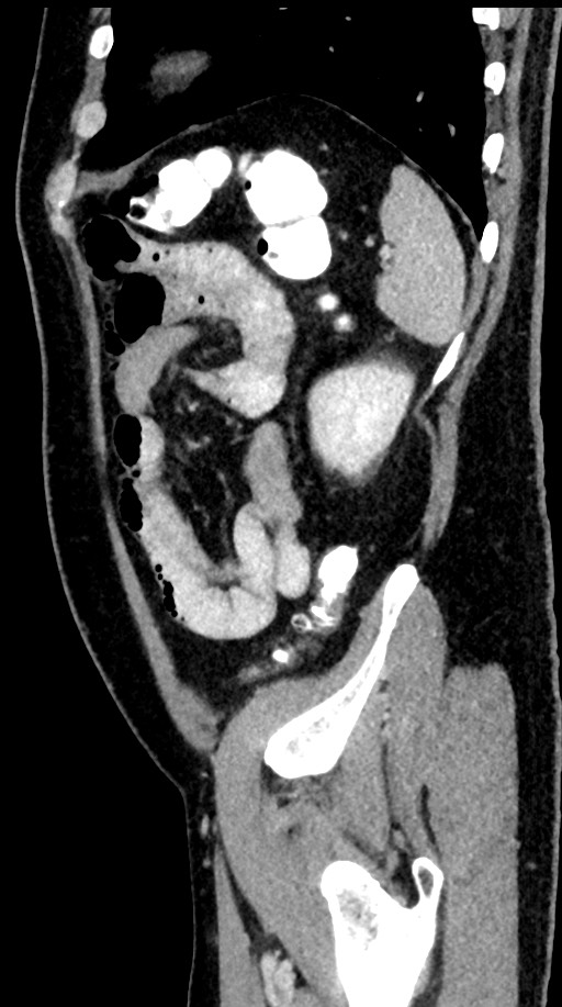 Acute appendicitis (Radiopaedia 77016-88960 Sagittal C+ portal venous phase 24).jpg