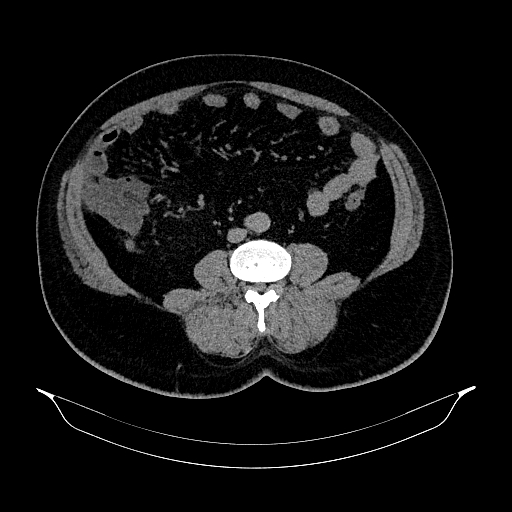 Acute appendicitis (Radiopaedia 79950-93224 Axial non-contrast 59).jpg
