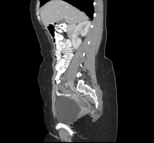 File:Acute appendicitis (Radiopaedia 9417-10099 Sagittal C+ portal venous phase 8).jpg