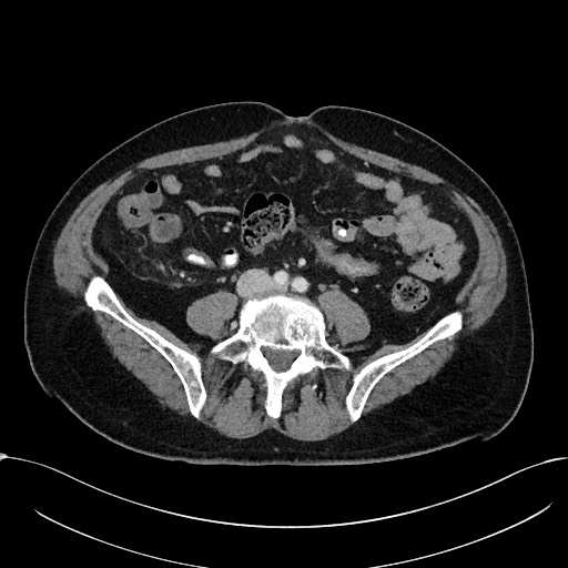 File:Acute appendicitis - large appendicoliths (Radiopaedia 61805-69820 Axial 4).jpg
