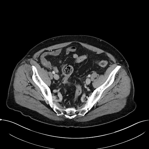 Acute appendicitis - large appendicoliths (Radiopaedia 61805-69820 Axial C+ portal venous phase 105).jpg