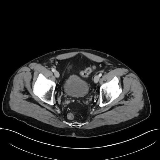 Acute appendicitis - large appendicoliths (Radiopaedia 61805-69820 Axial C+ portal venous phase 116).jpg