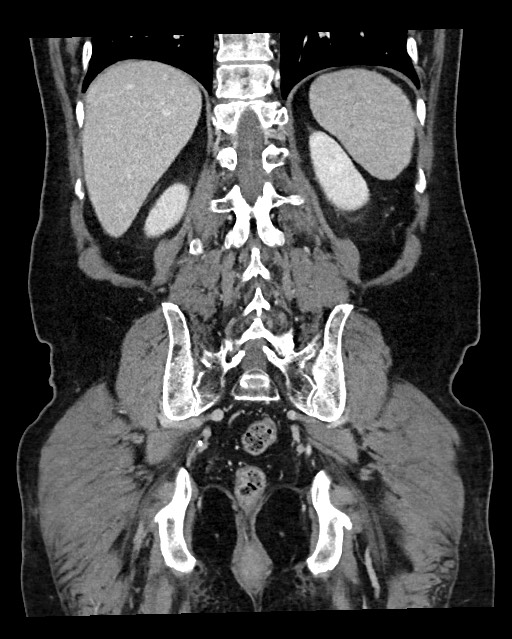 Acute appendicitis - large appendicoliths (Radiopaedia 61805-69820 Coronal C+ portal venous phase 102).jpg
