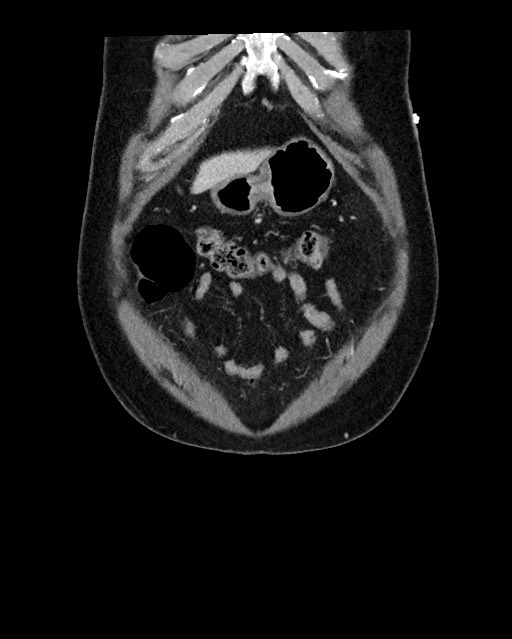 Acute appendicitis - large appendicoliths (Radiopaedia 61805-69820 Coronal C+ portal venous phase 24).jpg