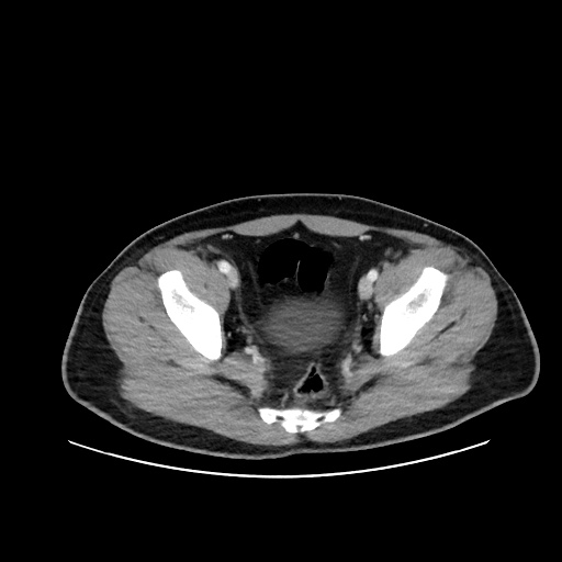 File:Acute appendicitis and COVID 19 pneumonia (Radiopaedia 76604-88380 Axial C+ portal venous phase 73).jpg