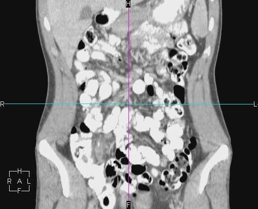 File:Acute appendicitis with CT arrowhead sign (Radiopaedia 21474-21411 Coronal C+ portal venous phase 4).JPG