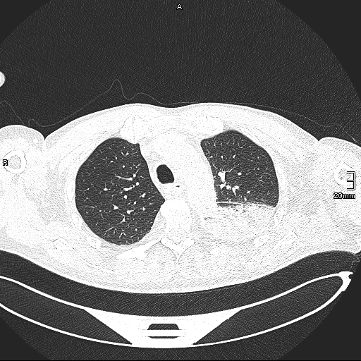 Acute aspiration pneumonitis (Radiopaedia 55642-62166 Axial lung window 49).jpg