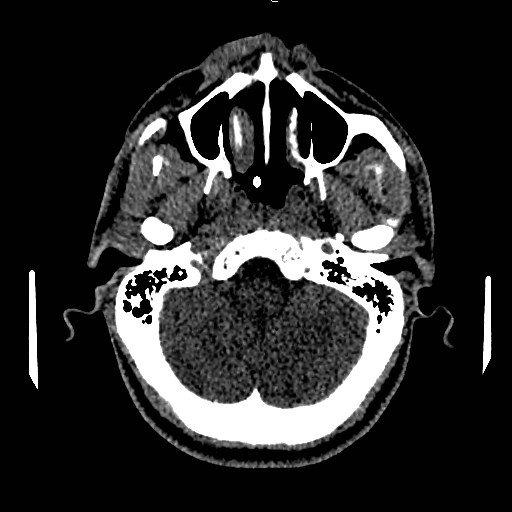 File:Acute basilar artery occlusion (Radiopaedia 43582-46985 Axial non-contrast 43).jpg