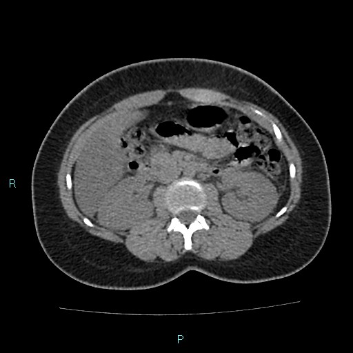 Acute bilateral pyelonephritis (Radiopaedia 37146-38881 Axial non-contrast 46).jpg