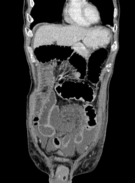 Acute bowel ischemia (Radiopaedia 87695-104114 Coronal C+ portal venous phase 116).jpg