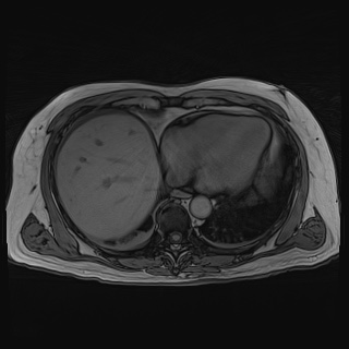 Acute cholecystitis (Radiopaedia 72392-82923 Axial T1 out-of-phase 21).jpg