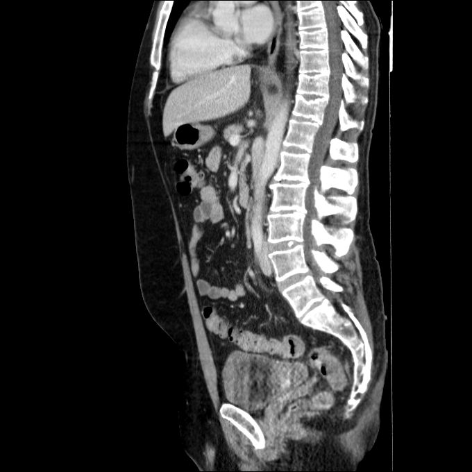 Acute cholecystitis and incidental left sided IVC (Radiopaedia 49352-54459 Sagittal C+ portal venous phase 45).jpg