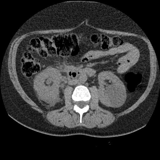 Acute cholecystitis and ureteric colic (Radiopaedia 42330-45444 Axial prone 46).jpg