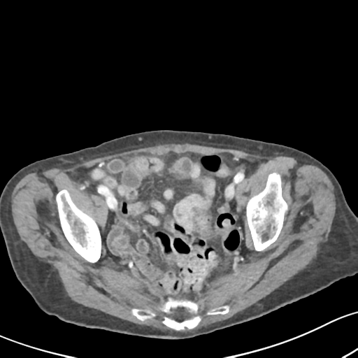 Acute cholecystitis with contained perforation (Radiopaedia 47328-51907 Axial C+ portal venous phase 61).png