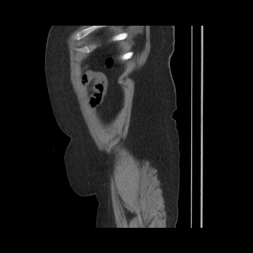 Acute cholecystitis with tensile fundus sign (Radiopaedia 71394-81723 Sagittal non-contrast 147).jpg