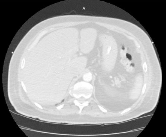 Acute cor pulmonale (ultrasound) (Radiopaedia 83508-98818 Axial lung window 91).jpg
