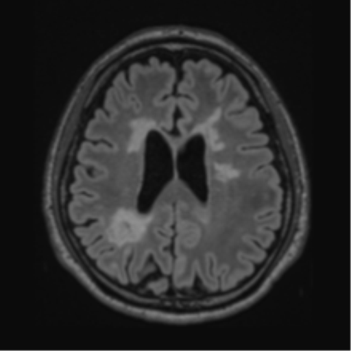 File:Acute disseminated encephalomyelitis (ADEM)- Anti-NMDA receptor encephalitis (Radiopaedia 54920-61201 Axial FLAIR 45).png