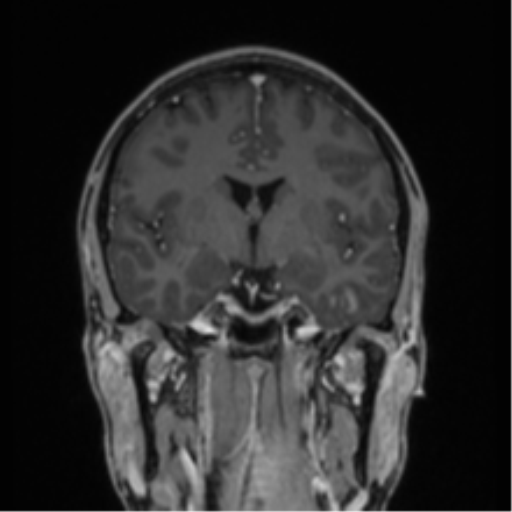 Acute disseminated encephalomyelitis (ADEM) (Radiopaedia 65319-74349 Coronal T1 C+ 28).png