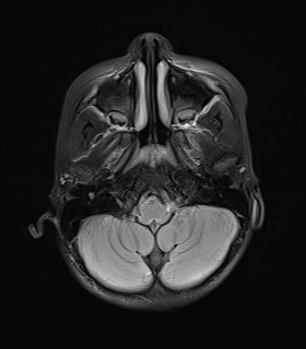 File:Acute disseminating encephalomyelitis with bilateral optic neuritis (Radiopaedia 79676-92886 Axial FLAIR 5).jpg