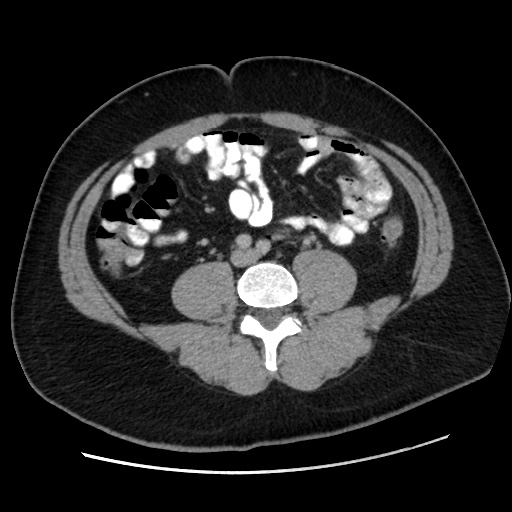 Acute diverticulitis with localized perforation (Radiopaedia 41296-44113 Axial C+ portal venous phase 55).jpg