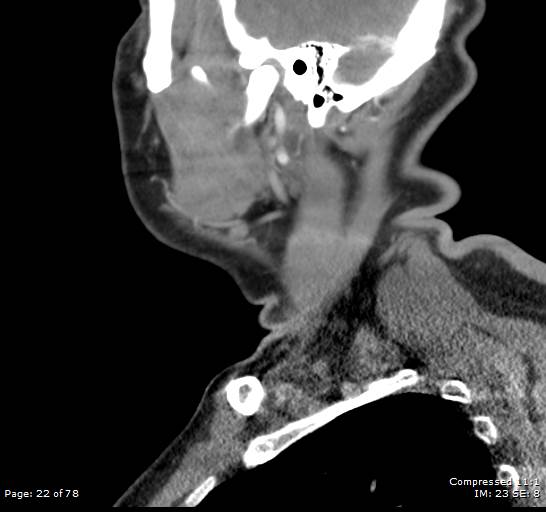 Acute epiglottitis (Radiopaedia 54375-60590 Sagittal C+ arterial phase 22).jpg