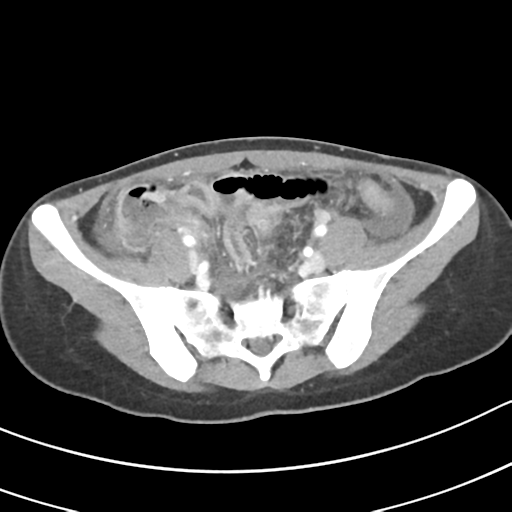 Acute gangrenous appendicitis with perforation (Radiopaedia 40152-42662 Axial C+ portal venous phase 54).png