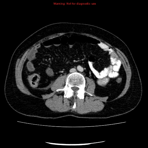 File:Acute gangrenous cholecystitis (Radiopaedia 10123-10661 Axial C+ portal venous phase 59).jpg