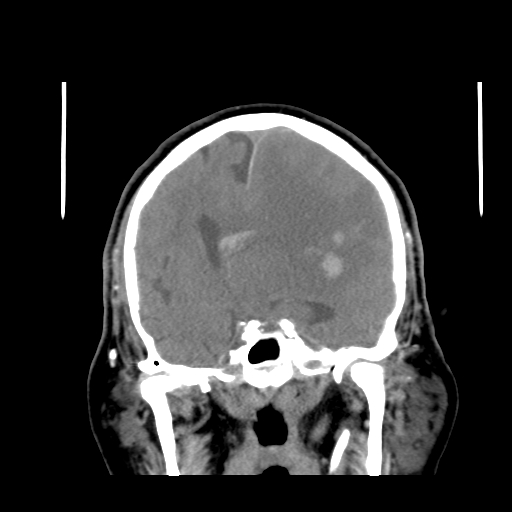 Acute hemorrhagic stroke (Radiopaedia 17507-17223 Coronal non-contrast 25).jpg