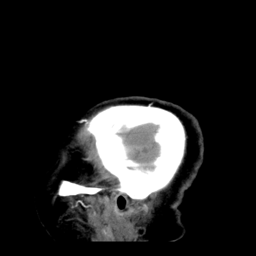 File:Acute hemorrhagic stroke (Radiopaedia 17507-17223 Sagittal non-contrast 43).jpg