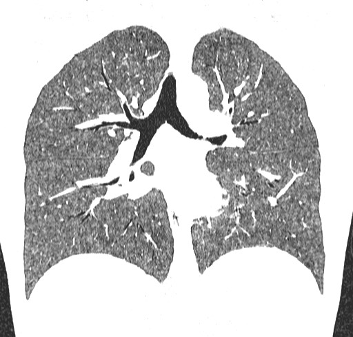 Acute hypersensitivity pneumonitis (Radiopaedia 85293-100870 Coronal lung window 73).jpg