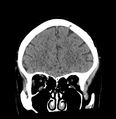 File:Acute internal carotid artery dissection (Radiopaedia 53541-59558 Coronal non-contrast 21).jpg