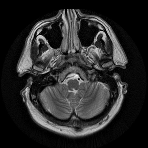 File:Acute internal carotid artery dissection (Radiopaedia 53541-59632 Axial T2 5).jpg