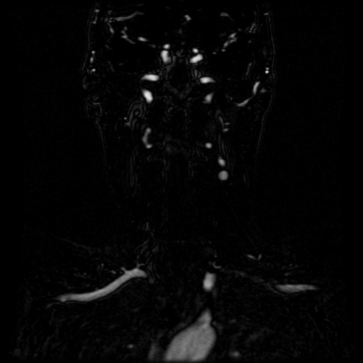 Acute internal carotid artery dissection (Radiopaedia 53541-59632 Coronal MRA 42).jpg
