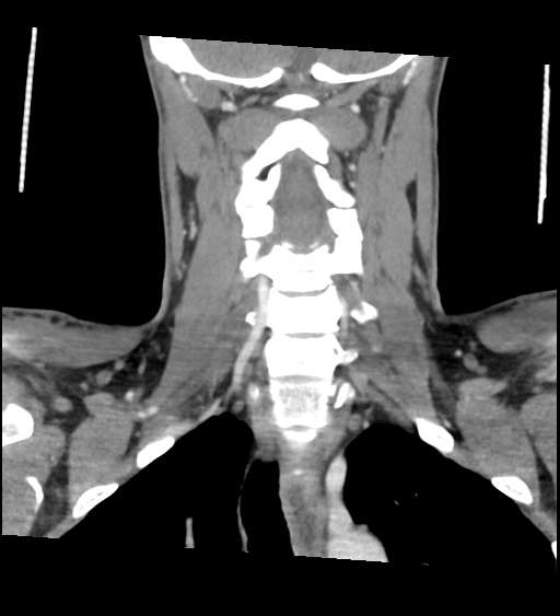 Acute longus colli calcific tendinitis (Radiopaedia 72495-83036 Coronal C+ arterial phase 45).jpg