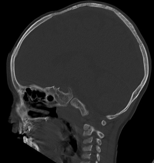 Acute mastoiditis (Radiopaedia 82678-96881 Sagittal bone window 36).jpg