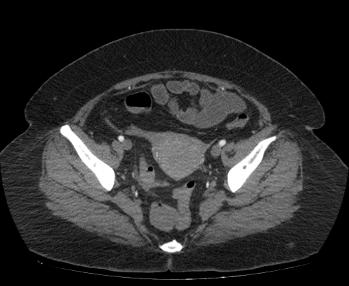 Acute mesenteric ischemia (Radiopaedia 80029-93316 Axial C+ arterial phase 113).jpg