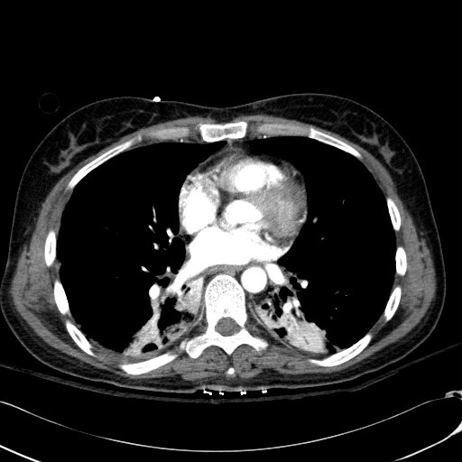 File:Acute myocardial infarction in CT (Radiopaedia 39947-42415 Axial C+ arterial phase 81).jpg